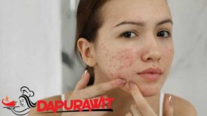 Skincare Untuk Kulit Berjerawat